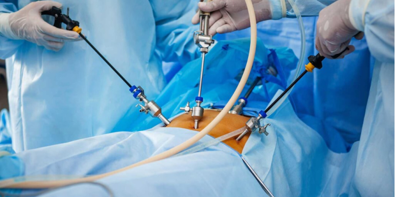 Laparoscopic-Surgery