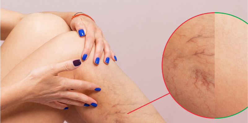 Varicose Vein Treatment