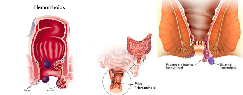 Piles Surgery at Care & Cure by Dr. Rakesh Dhupia Best Surgeon in Indore