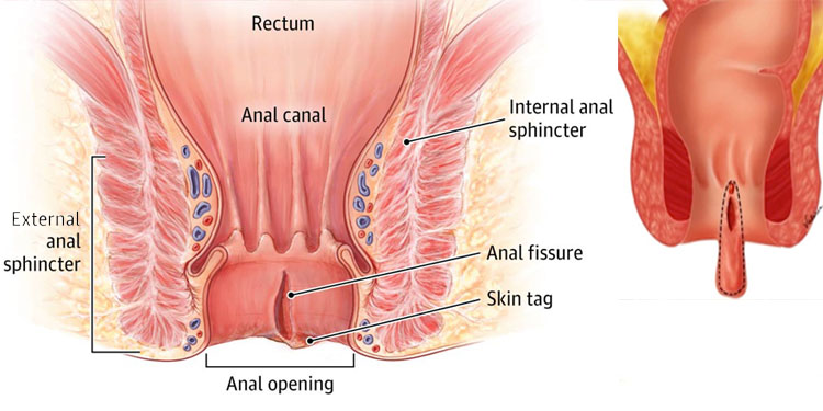 Fissure Treatment at Care & Cure by Dr. Rakesh Dhupia