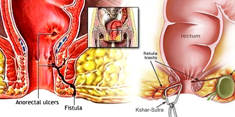 Fistula Treatment at Care & Cure by Dr. Rakesh Dhupia