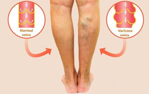 6 Signs You Might Need Varicose Veins Surgery