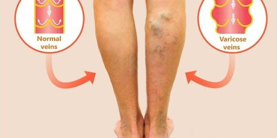 varicose-veins-new